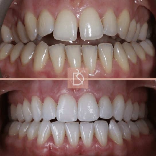 Lillie before and after Invisalign